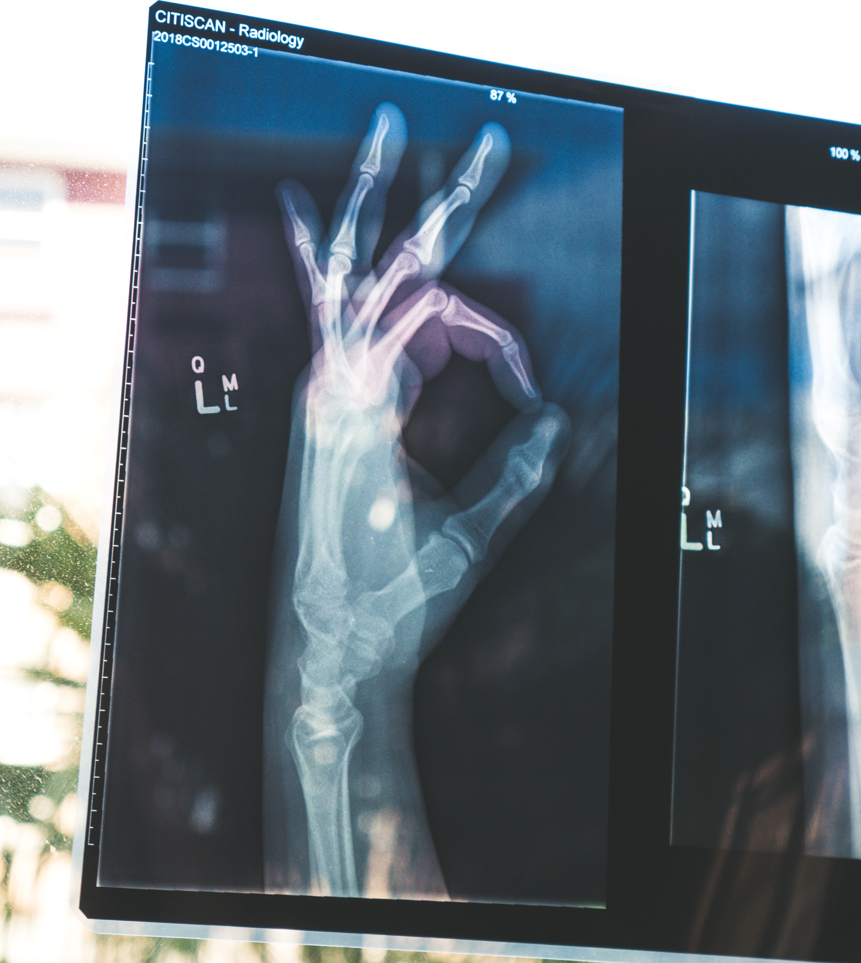 Röntgenbild einer Hand