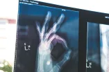 Röntgenbild einer Hand
