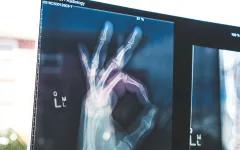 Röntgenbild einer Hand